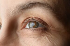 Primer plano de un ojo humano utilizado para ilustrar el glaucoma y la importancia de su detección temprana