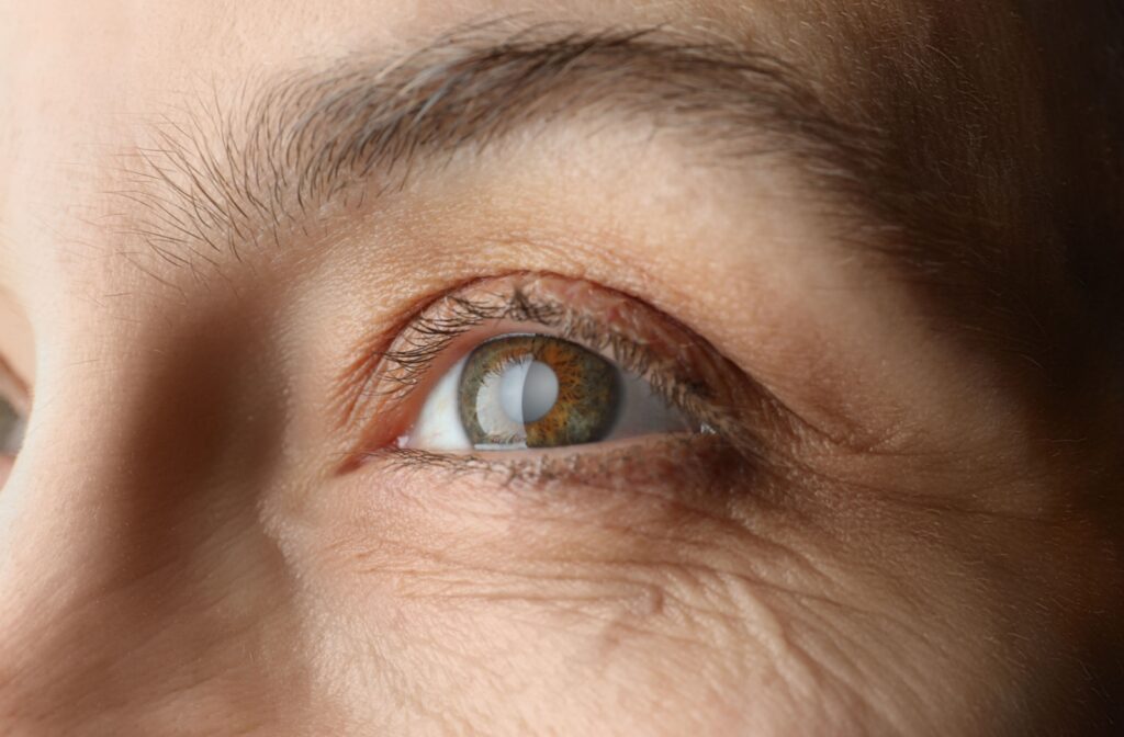 Primer plano de un ojo humano utilizado para ilustrar el glaucoma y la importancia de su detección temprana