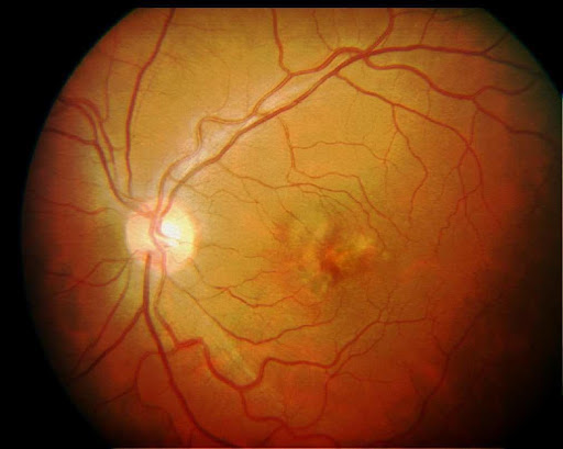 Fotografía de fondo de ojo que muestra cambios en la mácula asociados a degeneración macular relacionada con la edad (DMRE)