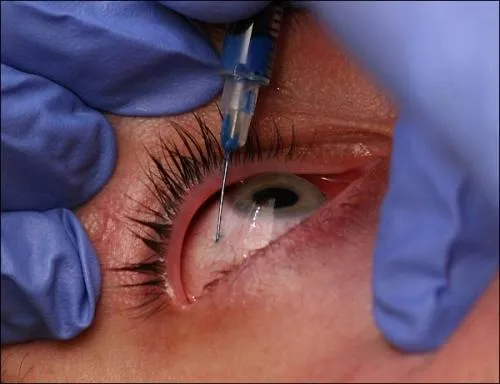 Aplicación de una inyección intravítrea para el tratamiento de enfermedades de la retina y la mácula