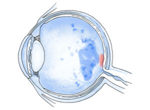 Ilustración de ojo afectado por retinopatía diabética con daño en la retina